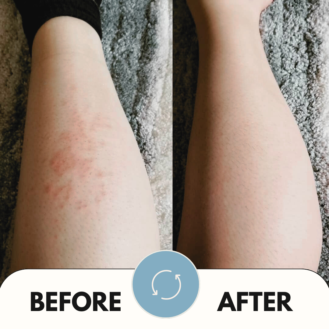 showing before and after photos of rash legs